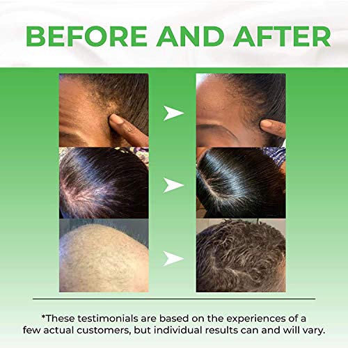 Biotin Hair Growth Serum Advanced Topical Formula To Help Grow Healthy, Strong Hair Suitable for Men and Women of All Hair Types Hair Loss Support By Pureauty Naturals